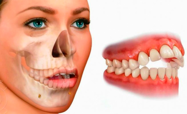 imagen-mordida-post-consejos-www.dentalpeñalver.com
