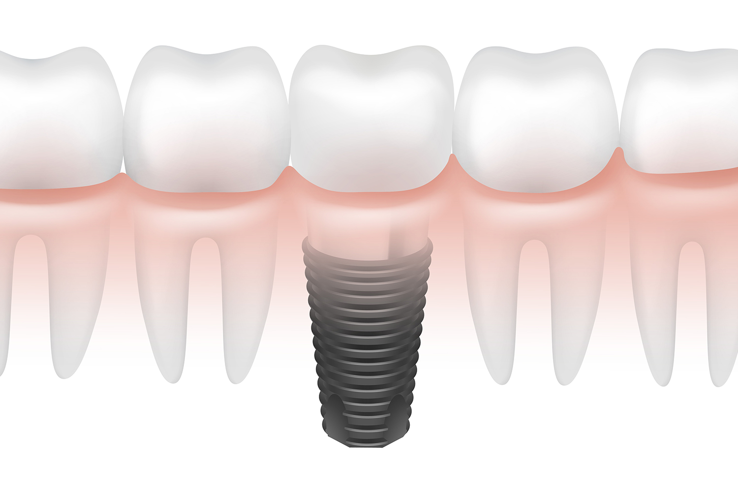 galeria-tratamientos-implantesdentales-www.dentalpenalver.com1