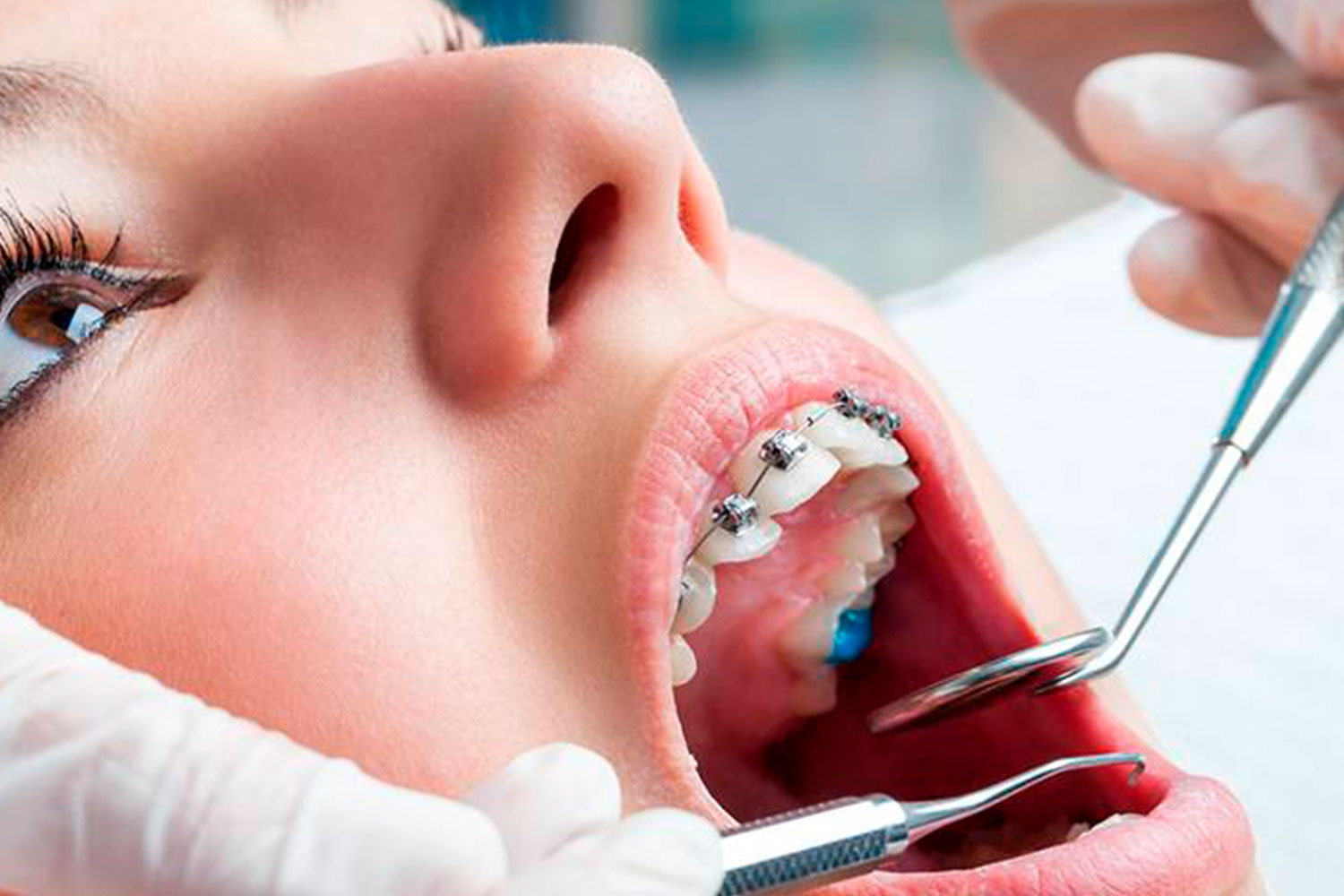 galeria-tratamientos-ortodoncia-www.dentalpenalver.com3