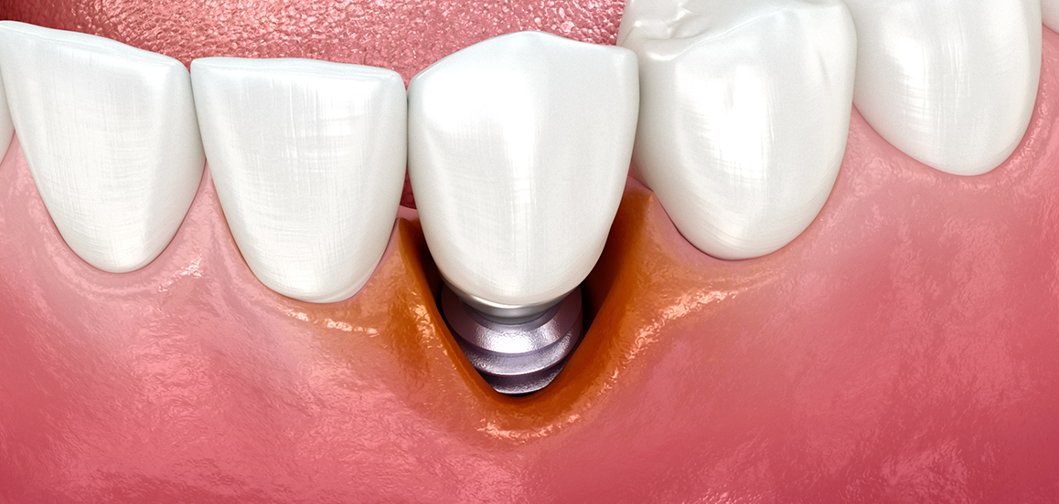 post-blog-periimplantitis-tratamiento-dental-penalver-cartagena-www.dentalpenalver.com_.jpg