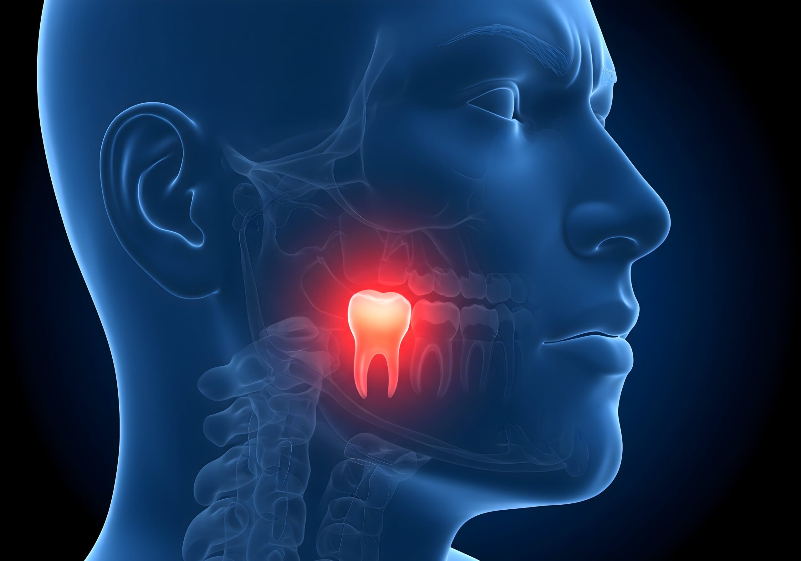 ¿Cuánto tarda en romper la encía la muela del juicio? - Clínica Dental