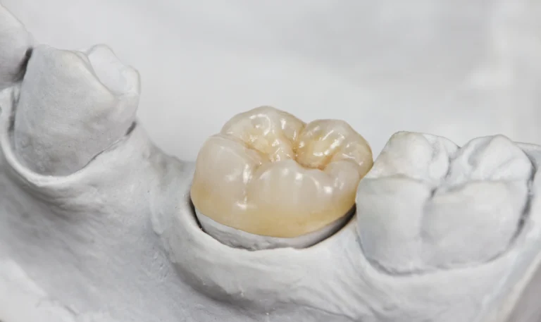 Corona de zirconio