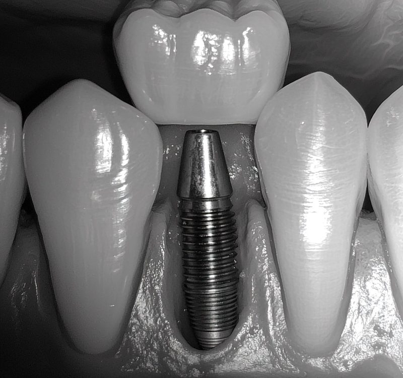 Implante dental Cartagena