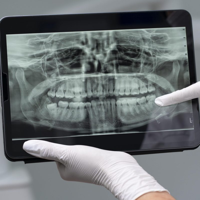 Radiografía para implante dental en Cartagena. para implante dental en Cartagena